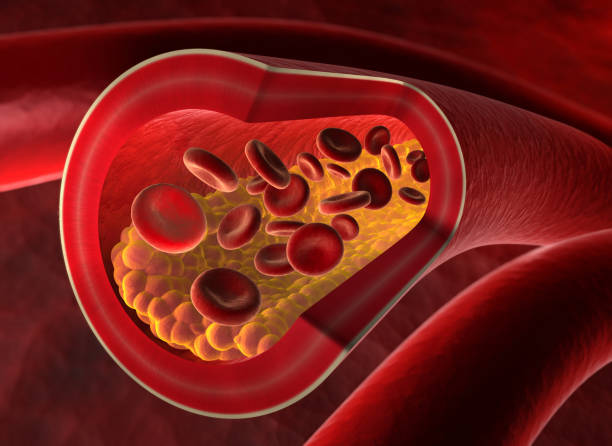 istock Artery blocked with cholesterol - stock photo 1170446398