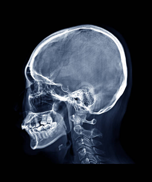 istock Skull x-ray image of Human skull  Lateral view or side view isolated on Black Background. 1170517711