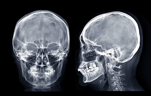 Imagen de rayos X del cráneo del cráneo humano AP y lateral aislado en fondo negro. photo