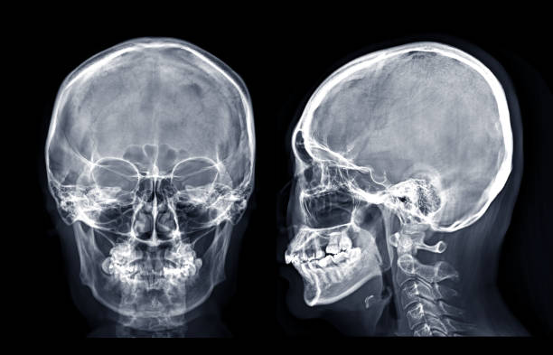 Skull x-ray image of Human skull  AP and Lateral  isolated on Black Background. stock photo