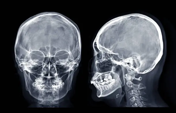 Photo of Skull x-ray image of Human skull  AP and Lateral  isolated on Black Background.