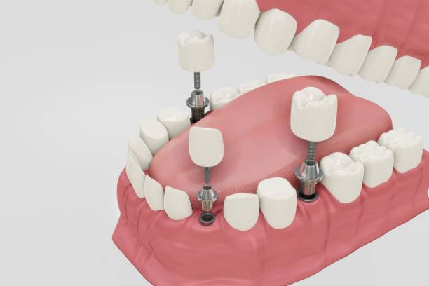 istock Dental Implants Treatment Procedure. Medically accurate 3D illustration dentures concept. 1170631222