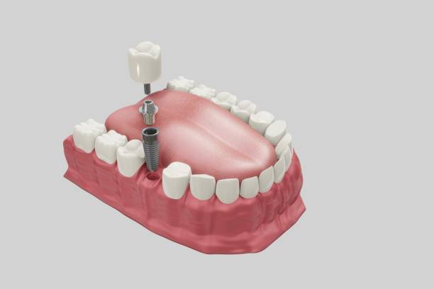 procedura di trattamento degli impianti dentali. concetto di protesi per illustrazioni 3d medicalmente accurate. - artificial metal healthcare and medicine technology foto e immagini stock