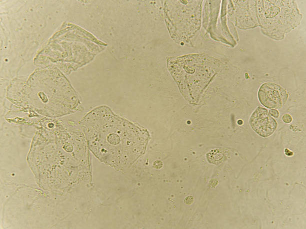 istock Epithelial cells with bacteria in patient urine 1170951000