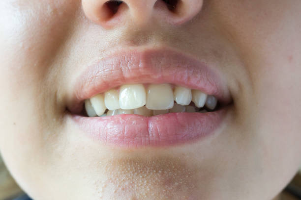 dientes torcidos de una joven de primer plano. - encorvado fotografías e imágenes de stock