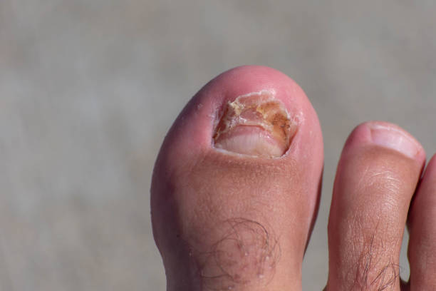 Big toe nail broken off and growing back after an injury. stock photo
