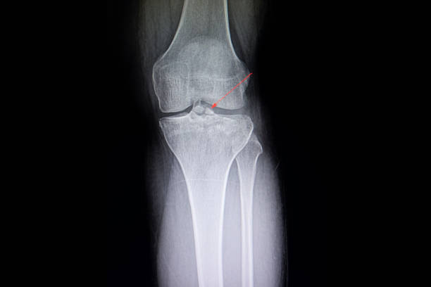 istock A fracture knee x-ray film 1171088200