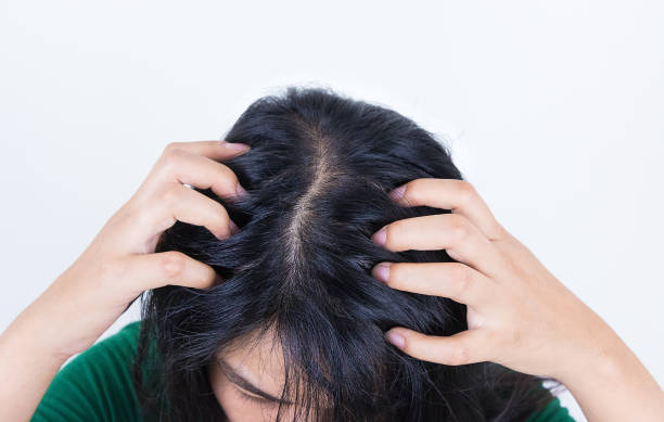 istock Woman suffering from itching her head, Itching scalp. 1171144939