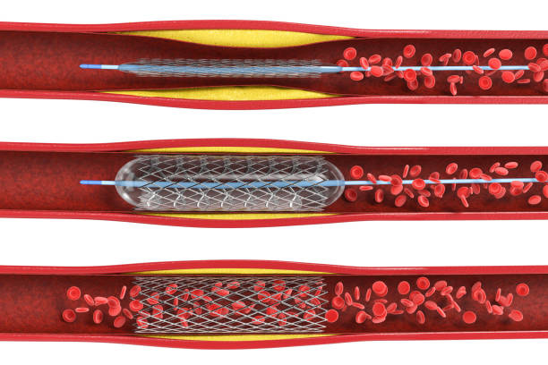 풍선 혈관 성형술 절차 - angioplasty 뉴스 사진 이미지