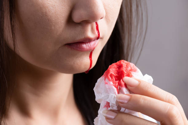 鼻血は、鼻出血に苦しむ若い女性で、出血を止めるためにティッシュペーパーを使用しています。ヘルスケアと医療の概念。 - people the human body human head human face ストックフォトと画像