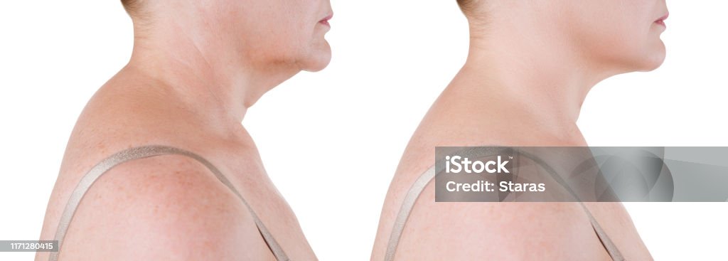 Skin rejuvenation on the neck, before after anti aging concept, wrinkle treatment, facelift and plastic surgery Skin rejuvenation on the neck, before after anti aging concept, wrinkle treatment, facelift and plastic surgery, half of body isolated on white background Animal Hump Stock Photo