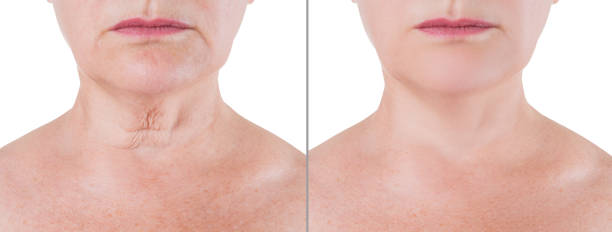 Skin rejuvenation on the neck, before after anti aging concept, wrinkle treatment, facelift and plastic surgery Skin rejuvenation on the neck, before after anti aging concept, wrinkle treatment, facelift and plastic surgery, half of body isolated on white background neck stock pictures, royalty-free photos & images