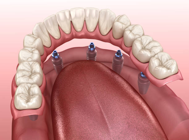 mandibular prosthesis with gum all on 6 system supported by implants.  medically accurate 3d illustration of human teeth and dentures concept - implantat imagens e fotografias de stock