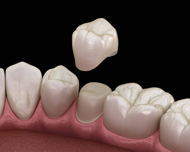 istock Preparated premolar tooth for dental crown placement. Medically accurate 3D illustration 1171332134