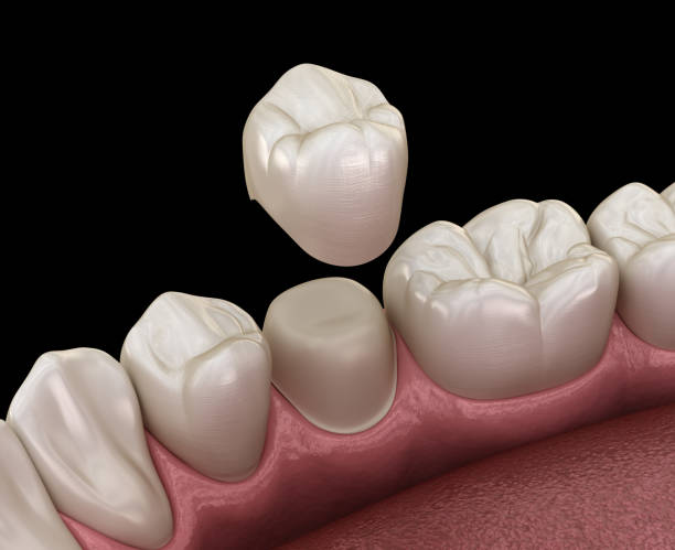 istock Preparated premolar tooth for dental crown placement. Medically accurate 3D illustration 1171332149