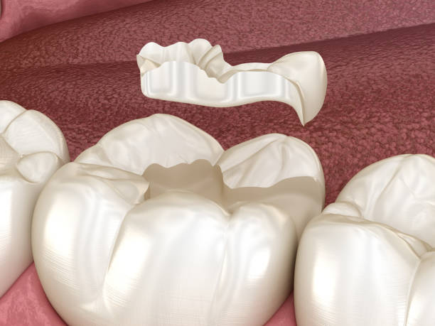 istock Inlay ceramic crown fixation over tooth. Medically accurate 3D illustration of human teeth treatment 1171332152