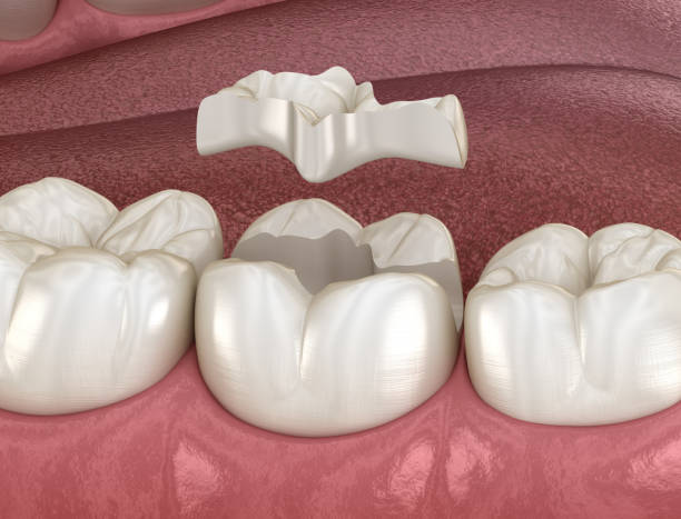 istock Inlay ceramic crown fixation over tooth. Medically accurate 3D illustration of human teeth treatment 1171332166