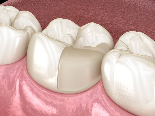 istock Onlay ceramic crown fixation over tooth. Medically accurate 3D illustration of human teeth treatment 1171332169
