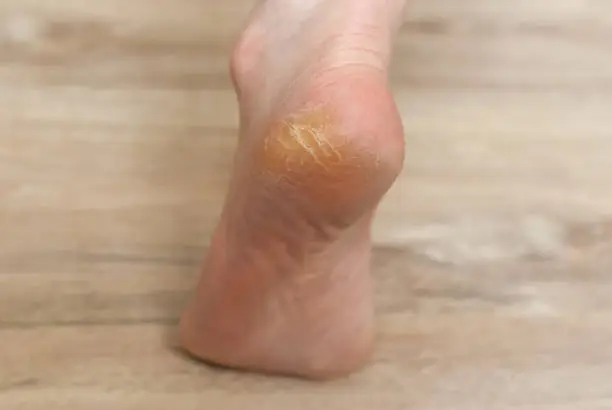 Photo of clavus and cracks on the heel of the foot