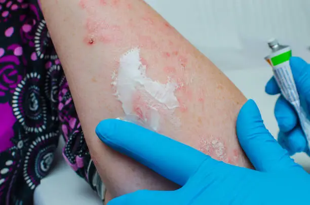 Photo of A dermatologist in gloves applies a therapeutic ointment to the affected skin of a patient with psoriasis. Treatment of chronic dermatoses - psoriasis, eczema, dermatitis.