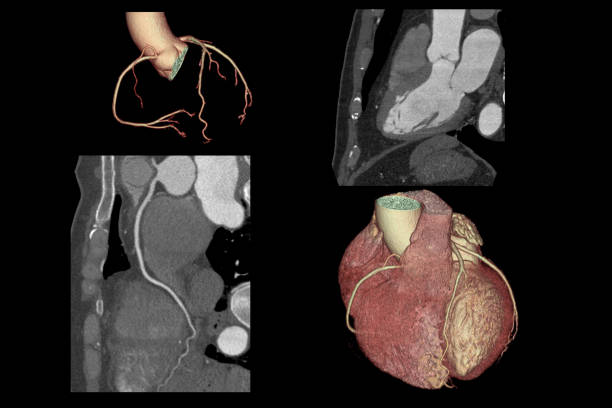 istock 3D SCAN CTA Coronary artery, coronary tree with long axis view and vessel trace. 1171358777