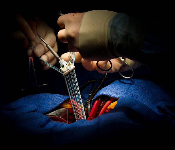 valve aortique remplacement avec bioprosthesis opération du coeur - valvule cardiaque photos et images de collection
