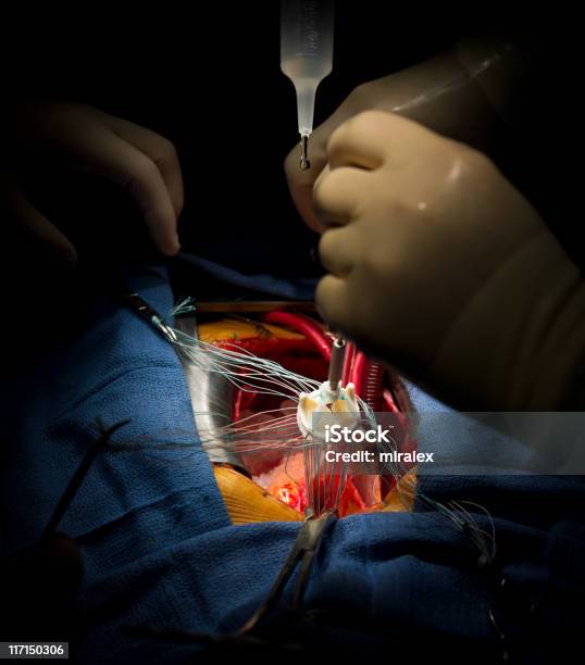 Intervento Di Chirurgia Cardiaca Valvola Aortica Sostituzione - Fotografie stock e altre immagini di Suturare