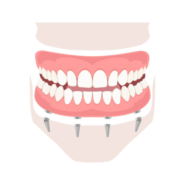 abnehmbarer prothesen auf implantaten - laboratory dentures dental hygiene human teeth stock-grafiken, -clipart, -cartoons und -symbole