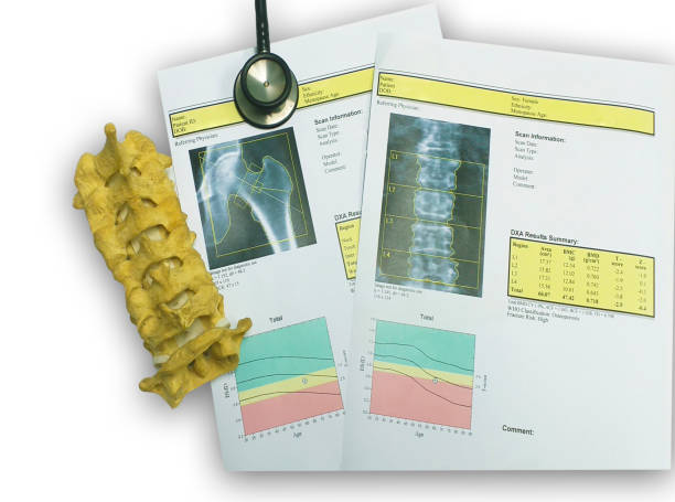 istock bone density hip and lumbarspine Result Osteoporosis 1171514741