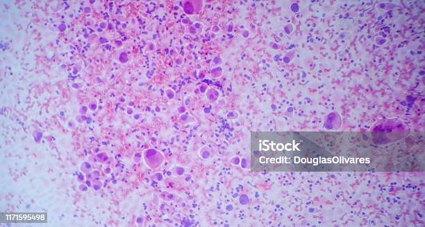 Microscopic Image Of A Cytology Of A Nonsmall Cell Lung Tumor Stock Photo - Download Image Now