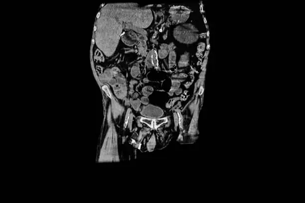 Photo of CAT - Scan of the abdomen showing calcification in aortic artery