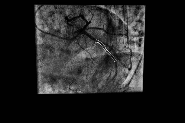 istock Heart Catheterization and stent implant 1171597277