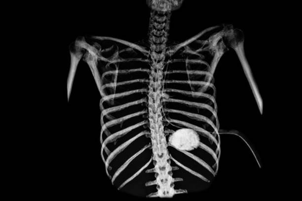 오른쪽 폐 동맥 총알과 왼쪽 피하 기종 및 왼쪽 가슴 튜브를 보여주는 성숙한 남자 x 선 - x ray x ray image bullet shooting 뉴스 사진 이미지
