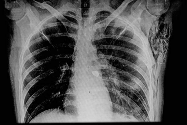 Mature man X-ray  showing a right pulmonary  artery bullet and left subcutaneous emphysema stock photo