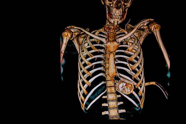 고양이 - 오른쪽 폐 동맥 총알과 왼쪽 피하 폐기종 및 왼쪽 흉부 튜브를 보여주는 스캔 - x ray x ray image bullet shooting 뉴스 사진 이미지