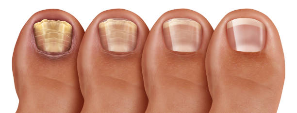pilz nagelinfektion erholung - toenail stock-fotos und bilder