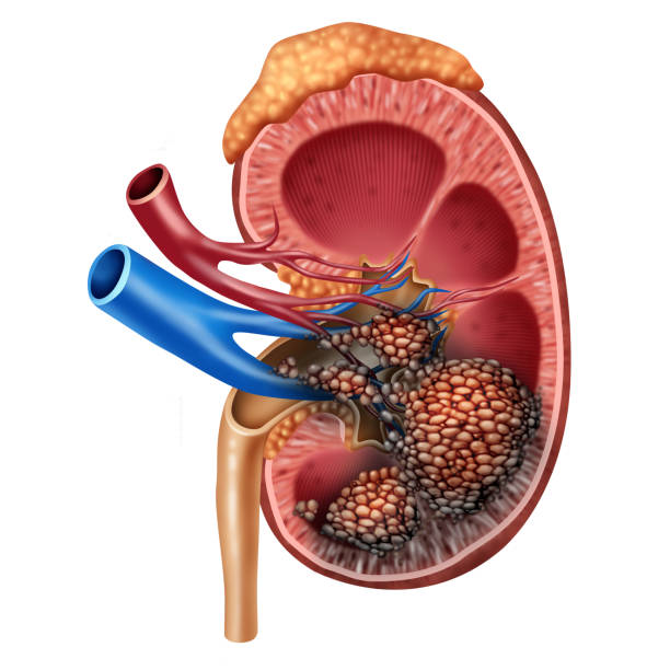 human kidney cancer anatomy - kidney cancer imagens e fotografias de stock