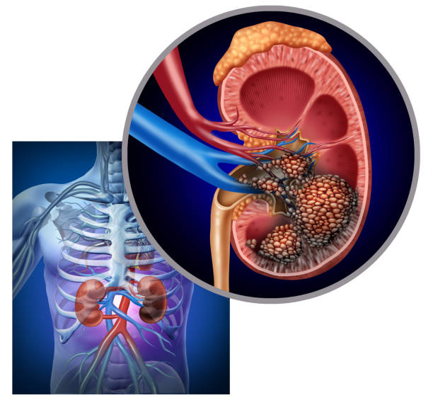 rak nerki - kidney cancer zdjęcia i obrazy z banku zdjęć