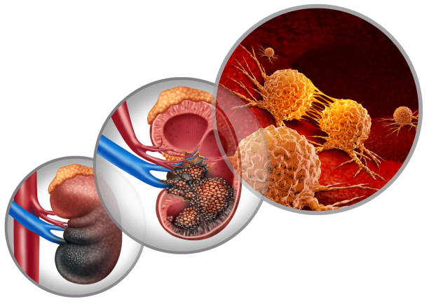 Kidney Cancer Disease Kidney cancer disease medical concept as malignant cells in a human body attacking the urinary system and renal carcinoma anatomy as a symbol for tumor growth treatment and risk with 3D illustration elements. kidney organ stock pictures, royalty-free photos & images