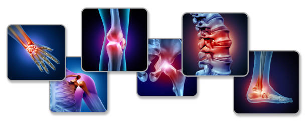 Pain Of The Joints Pain of the joints concept as skeleton and muscle anatomy of the body with a group of sore joints as a painful injury or arthritis illness symbol for health care and medical symptoms with 3D illustration elements. inflammation photos stock pictures, royalty-free photos & images