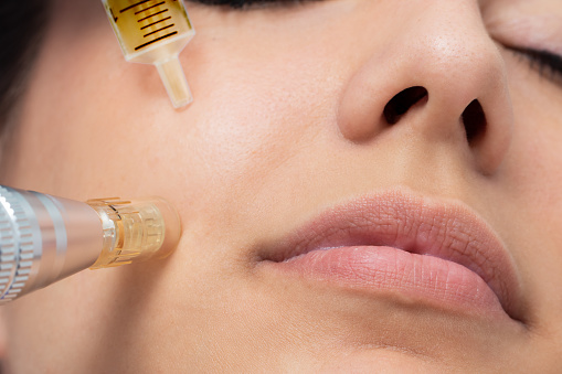 Macro detalle del tratamiento cosmético micro aguja en la mejilla femenina. photo