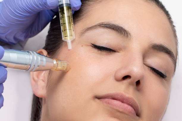 Woman having derma pen facial treatment. Close up of young woman having cosmetic mesotherapy facial. Therapist injecting pharmaceuticals with derma pen on cheek. ampoule photos stock pictures, royalty-free photos & images