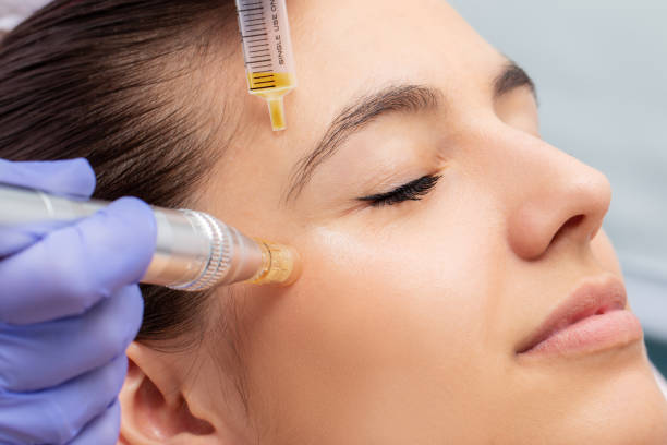istock Woman having micro needling treatment reducing crow's feet 1171697897
