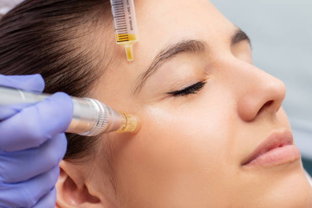 Woman having micro needling treatment reducing crow's feet Macro close up of therapist injecting enzymes and with derma pen around woman's eyes. collagen photos stock pictures, royalty-free photos & images