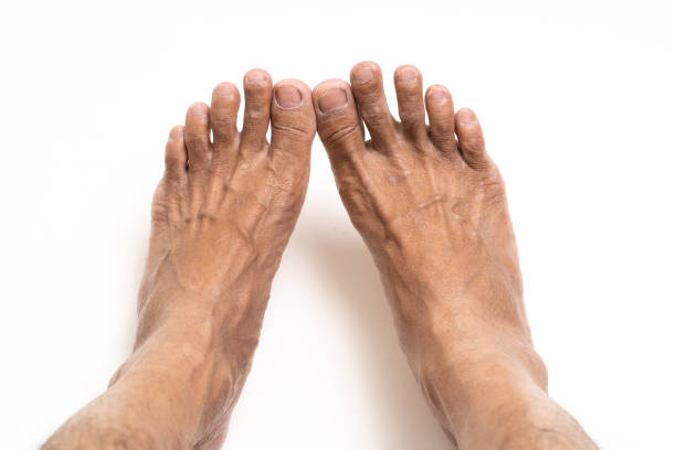 istock Asian man foot brown and dry skin 1171712687