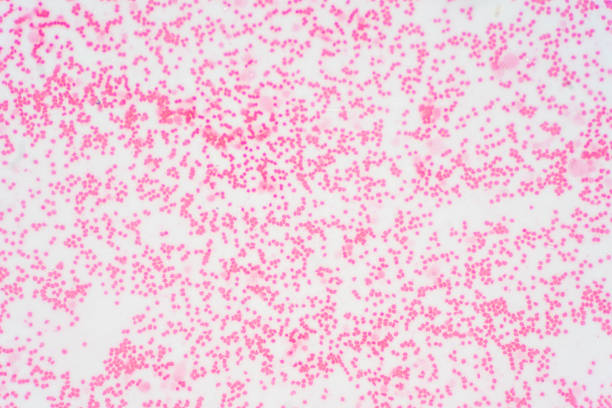 istock Bone marrow biopsy from myelodysplastic condition under the microscope view. Histology tissue of bone marrow biopsy. 1171819777