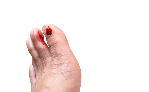 istock Fresh wounds on the floor man's toe nails on isolated white background with clipping path. 1171822038