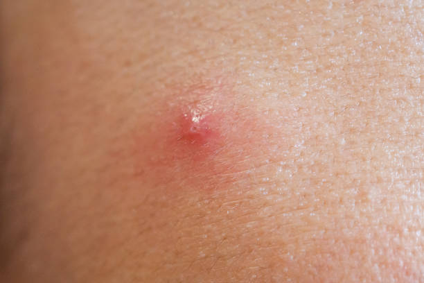 istock Inflammatory acne with red spot on face closeup 1171824587