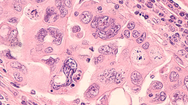 Ovarian Serous Carcinoma High power photomicrograph of a serous papillary carcinoma of the ovary, an aggressive type of ovarian cancer,  demonstrating prominent nuclear pleomorphism. adenocarcinoma photos stock pictures, royalty-free photos & images
