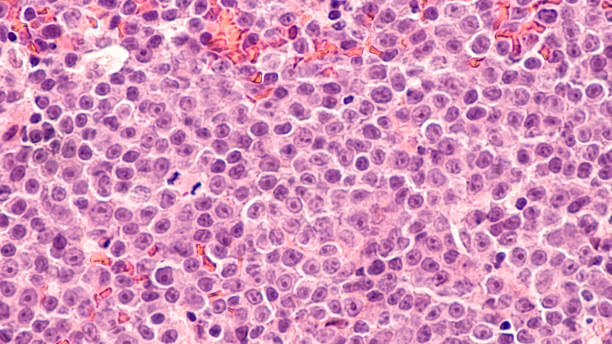 Diffuse Large B-cell Lymphoma Lymphoma awareness: photomicrograph of a diffuse large B-cell lymphoma (DLBCL) a type of non-Hodgkin lymphoma. This case is from the testis of an elderly man and shows prominent nucleoli. lymphoma photos stock pictures, royalty-free photos & images